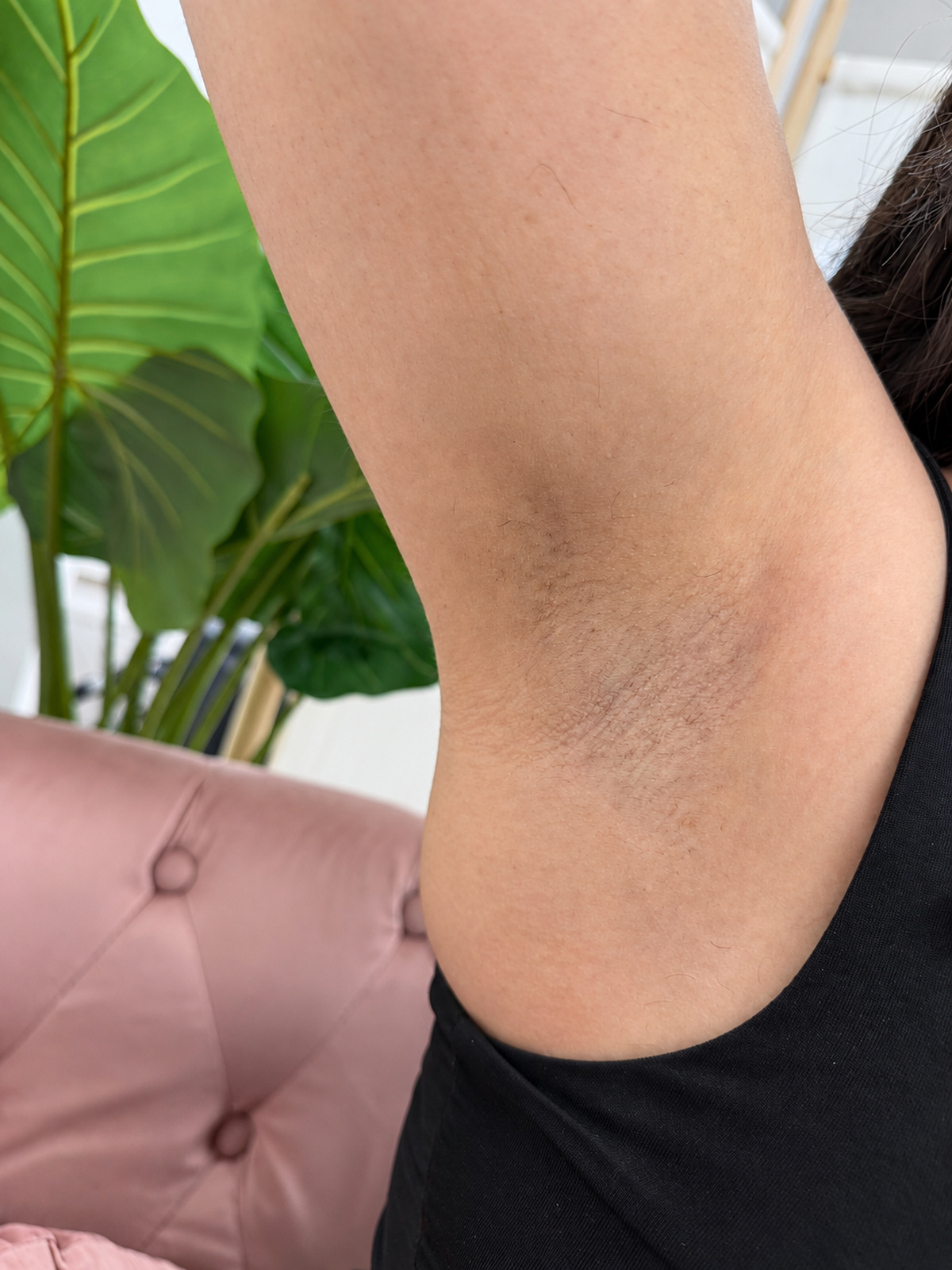 Aisselle après l'épilation laser — peau nette